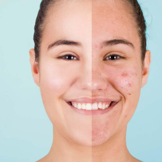 Best Korean Skincare Products for Acne