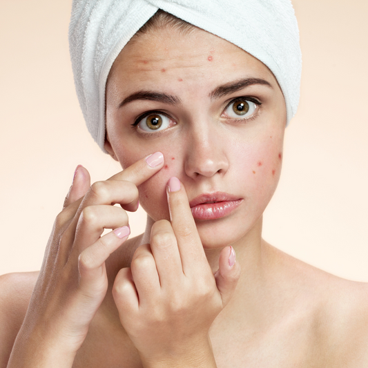 Comedones Skincare Guide Spots and Pimples